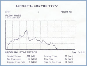 Uroflowmetry - used to detect the deficinecy in urinary tract by  non-invasive method